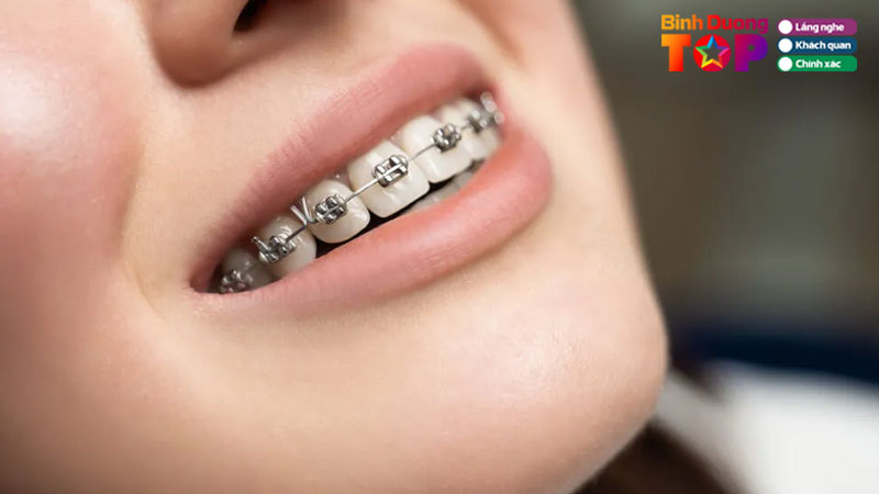 Top-10-dia-chi-nieng-rang-binh-duong-tham-my-co-tra-gop-binhduongtoplist