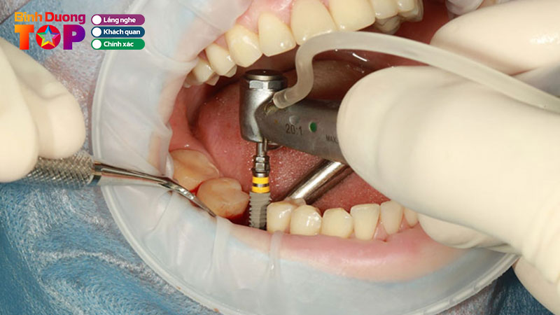 Top-10-dia-chi-trong-rang-implant-o-binh-duong-tham-my-an-toan-binhduongtoplist